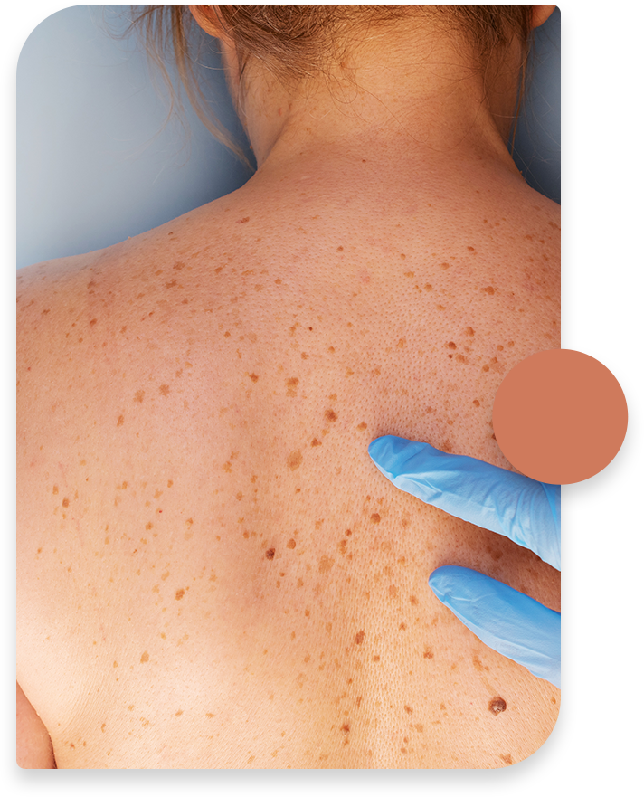 Skin Cancer of Treatment Options-01